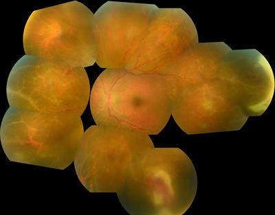 Acute retinal necrosis: A mini review